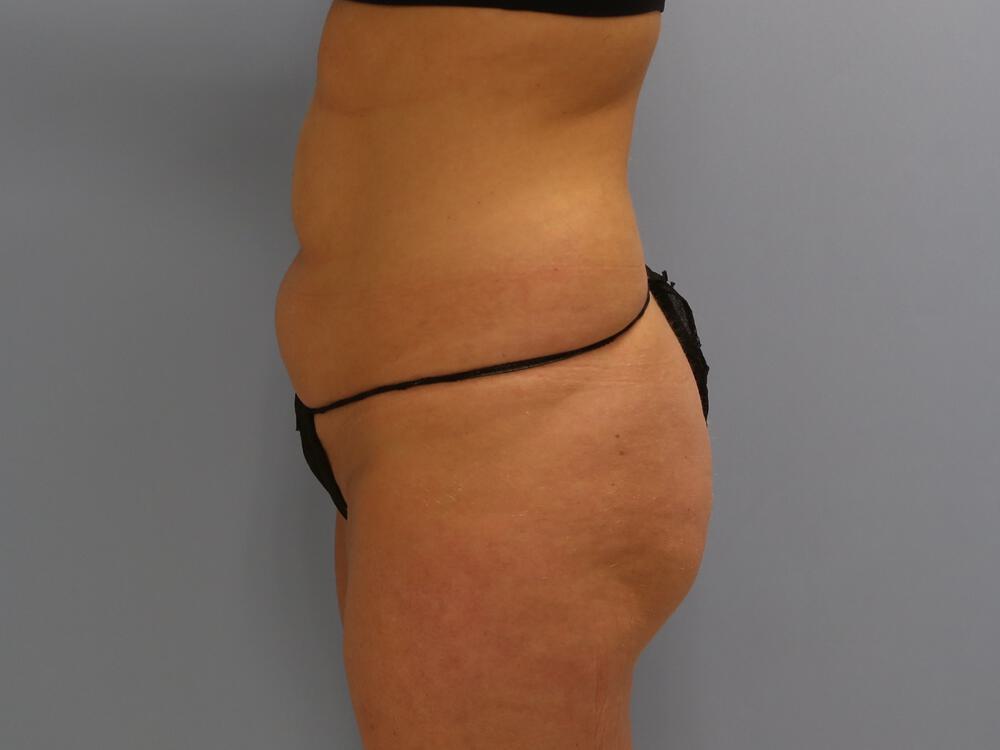 Buttocks Reshaping Before & After Image