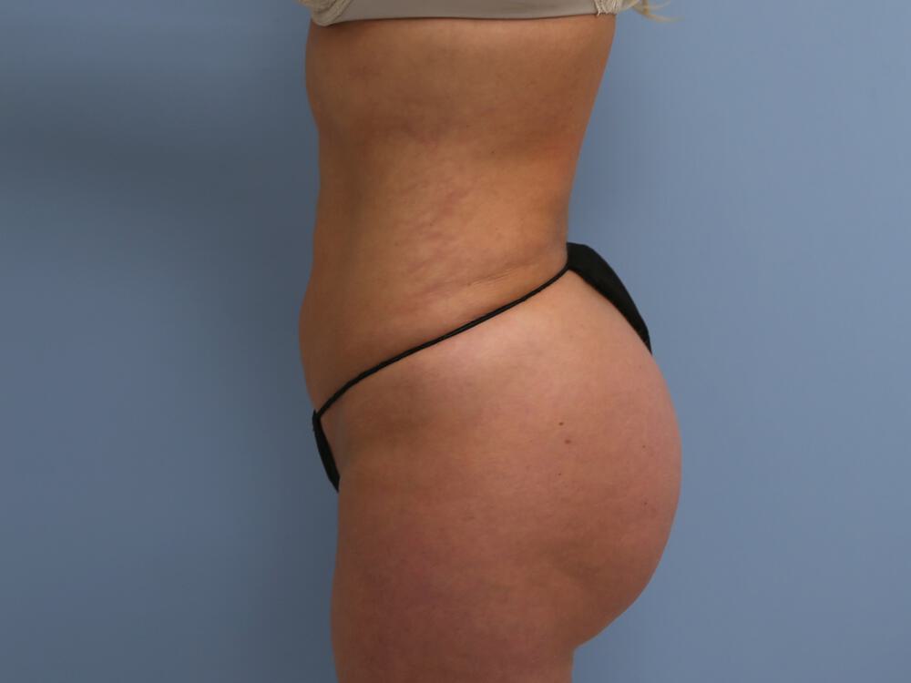 Buttocks Reshaping Before & After Image