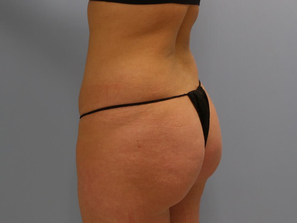 Buttocks Reshaping Before & After Image