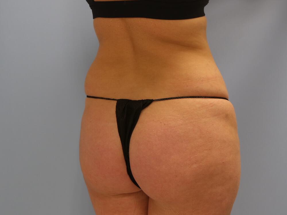 Buttocks Reshaping Before & After Image