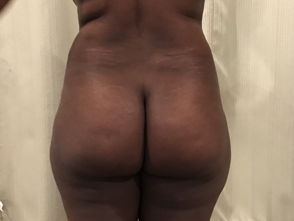 Buttocks Reshaping Before & After Image