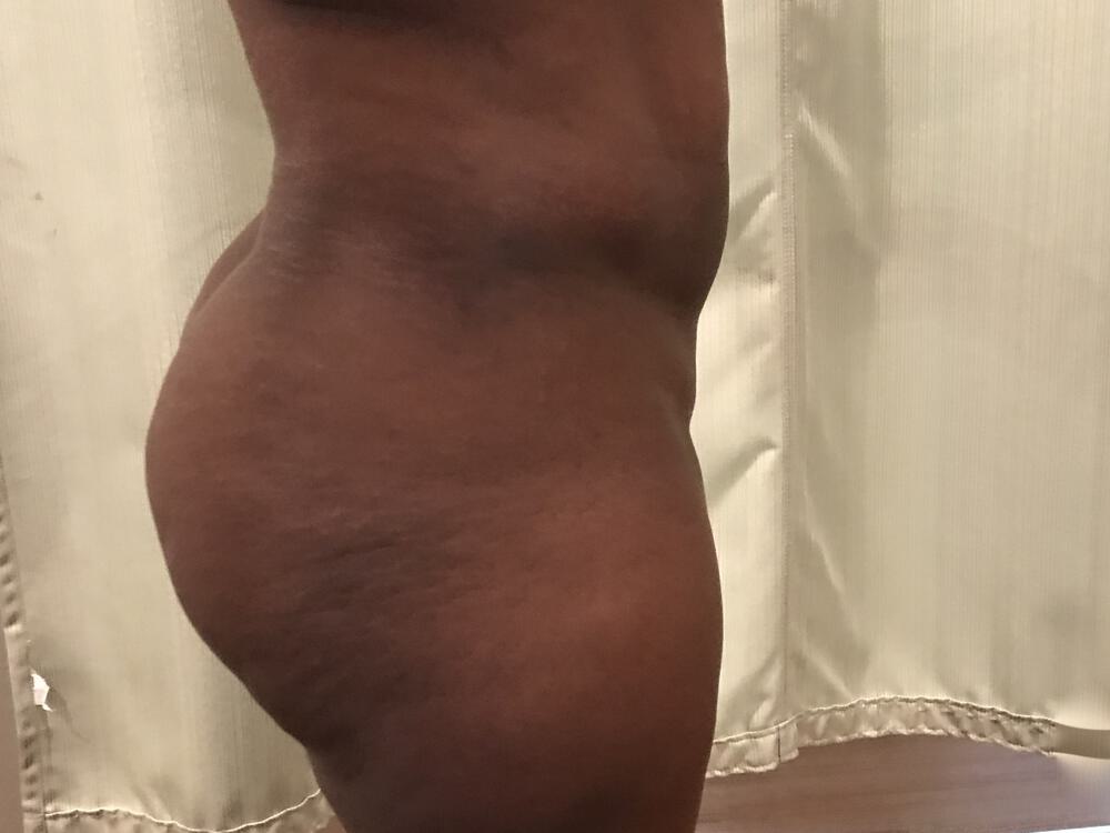 Buttocks Reshaping Before & After Image