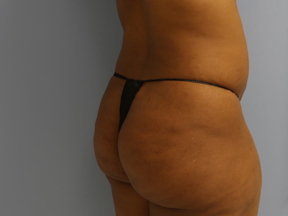 Buttocks Reshaping Before & After Image