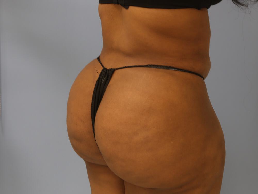 Buttocks Reshaping Before & After Image