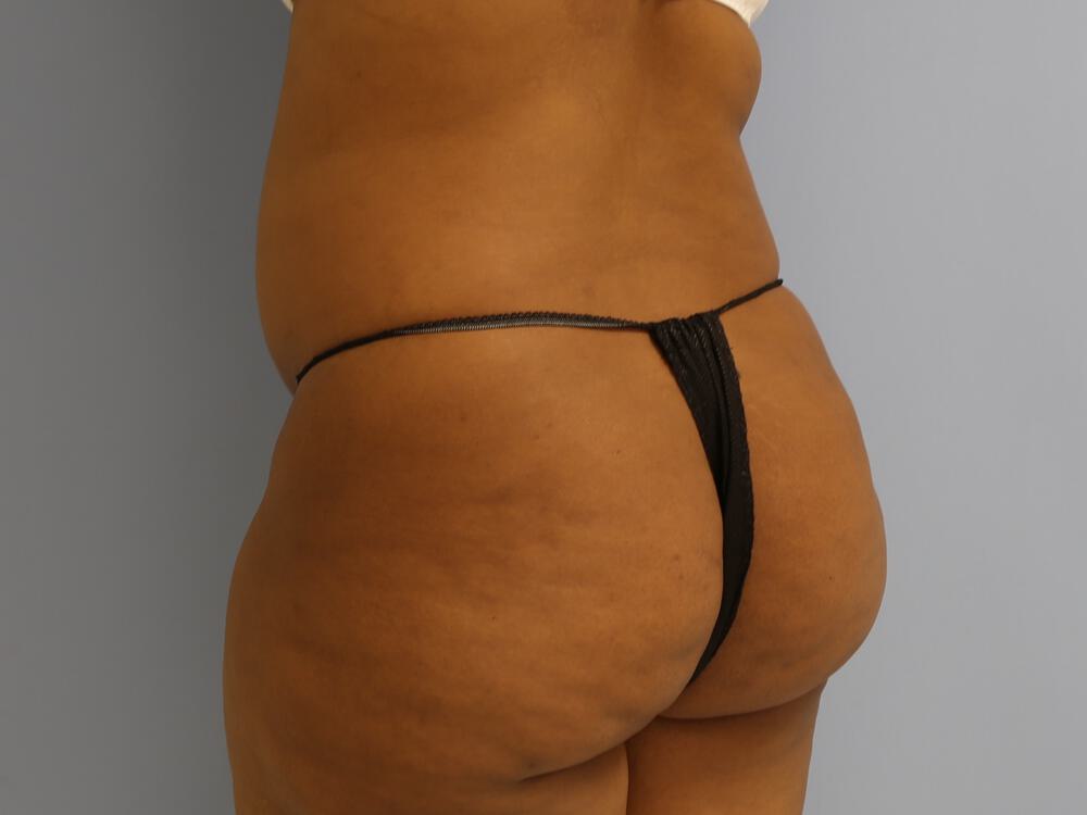 Buttocks Reshaping Before & After Image