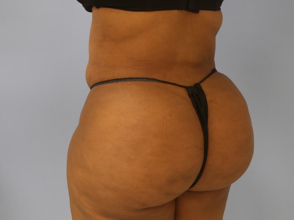 Buttocks Reshaping Before & After Image