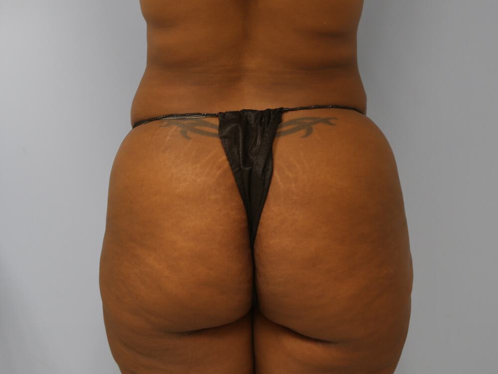 Buttocks Reshaping Before & After Image