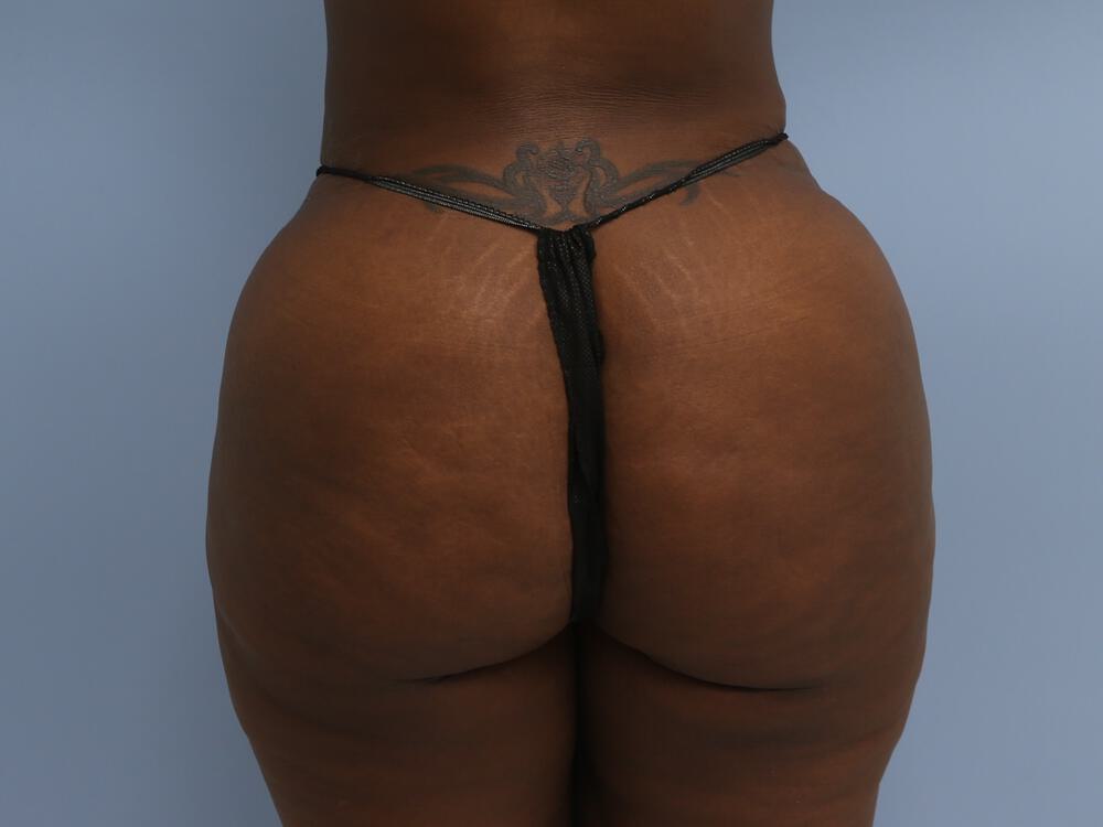 Buttocks Reshaping Before & After Image