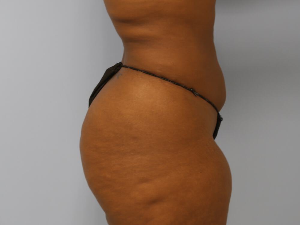 Buttocks Reshaping Before & After Image