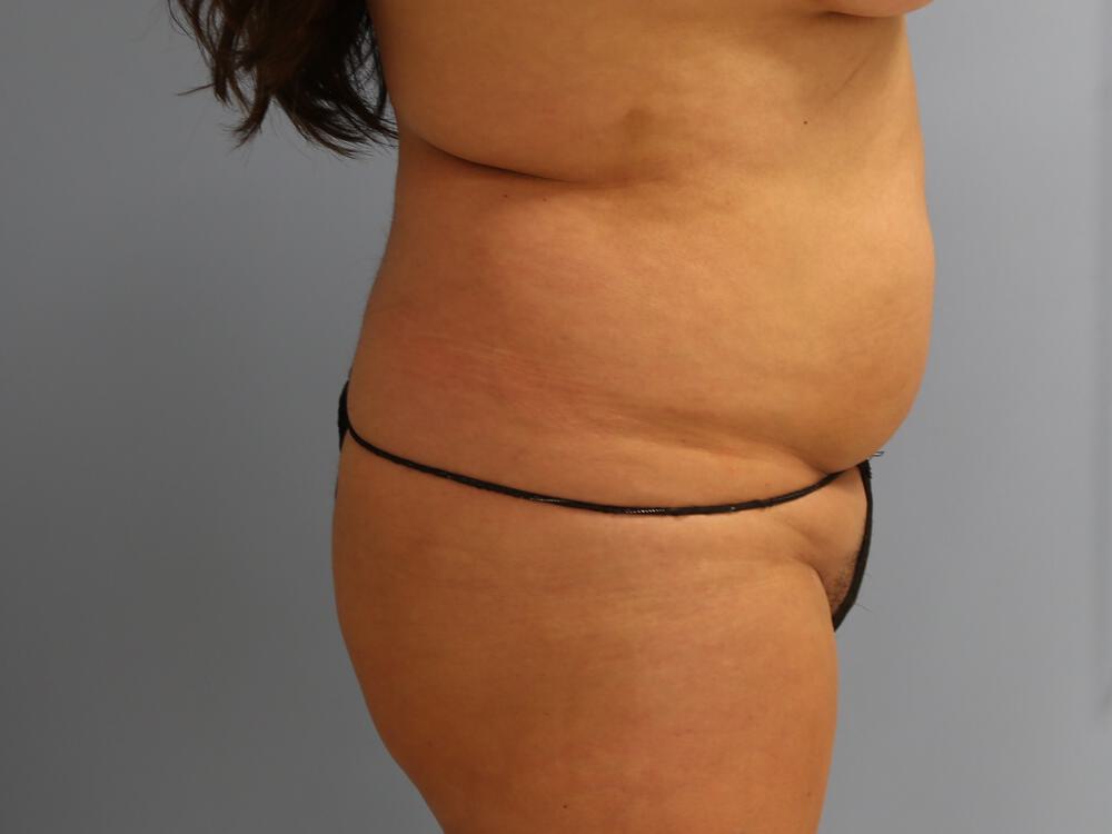 Buttocks Reshaping Before & After Image