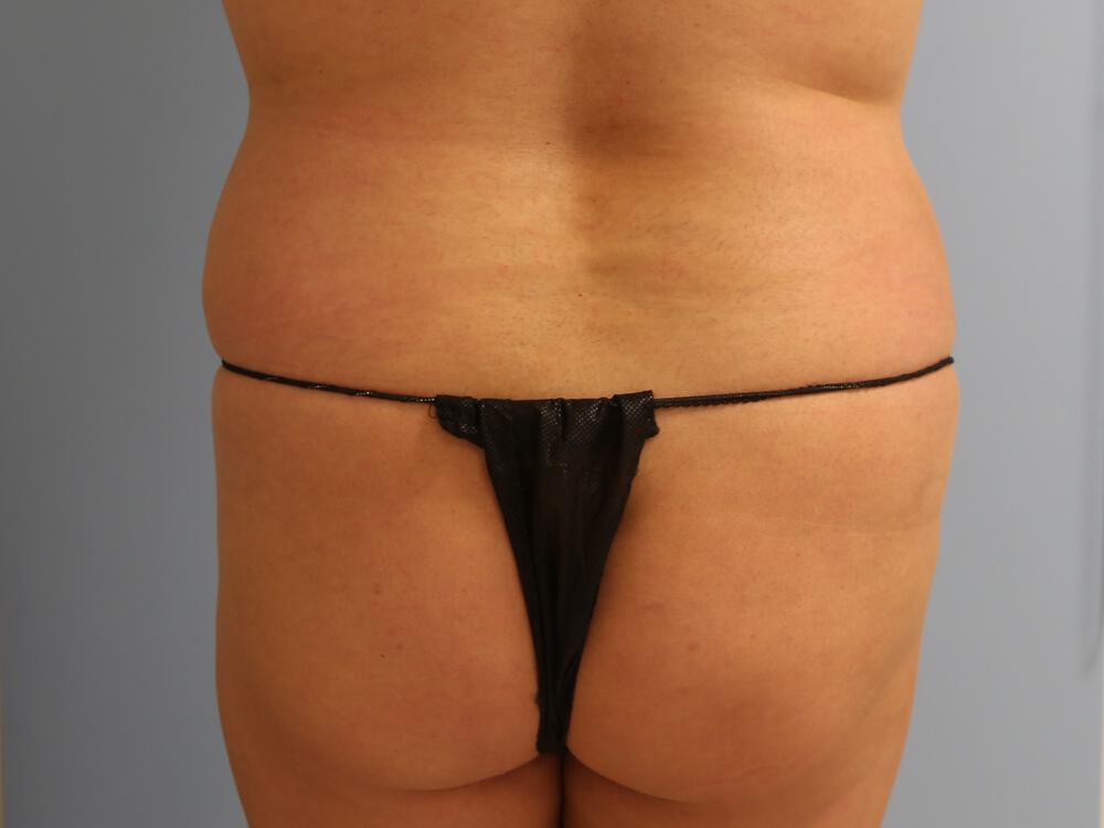 Buttocks Reshaping Before & After Image