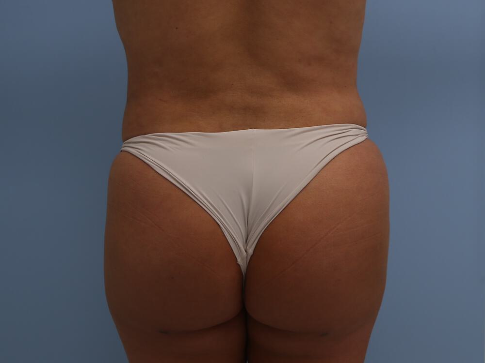 Buttocks Reshaping Before & After Image