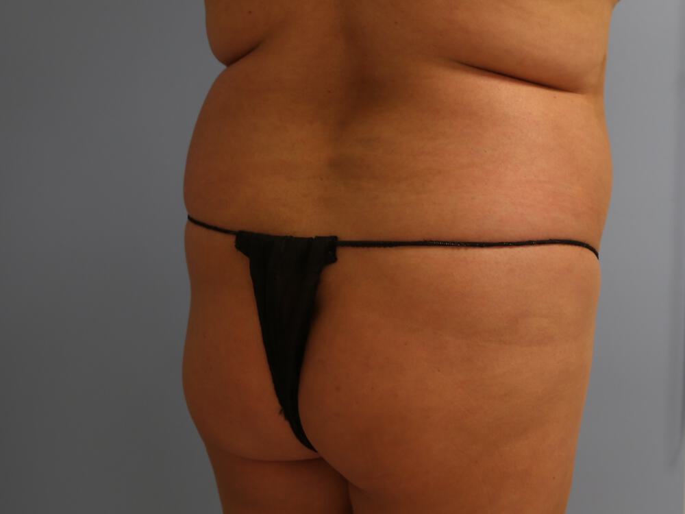 Buttocks Reshaping Before & After Image