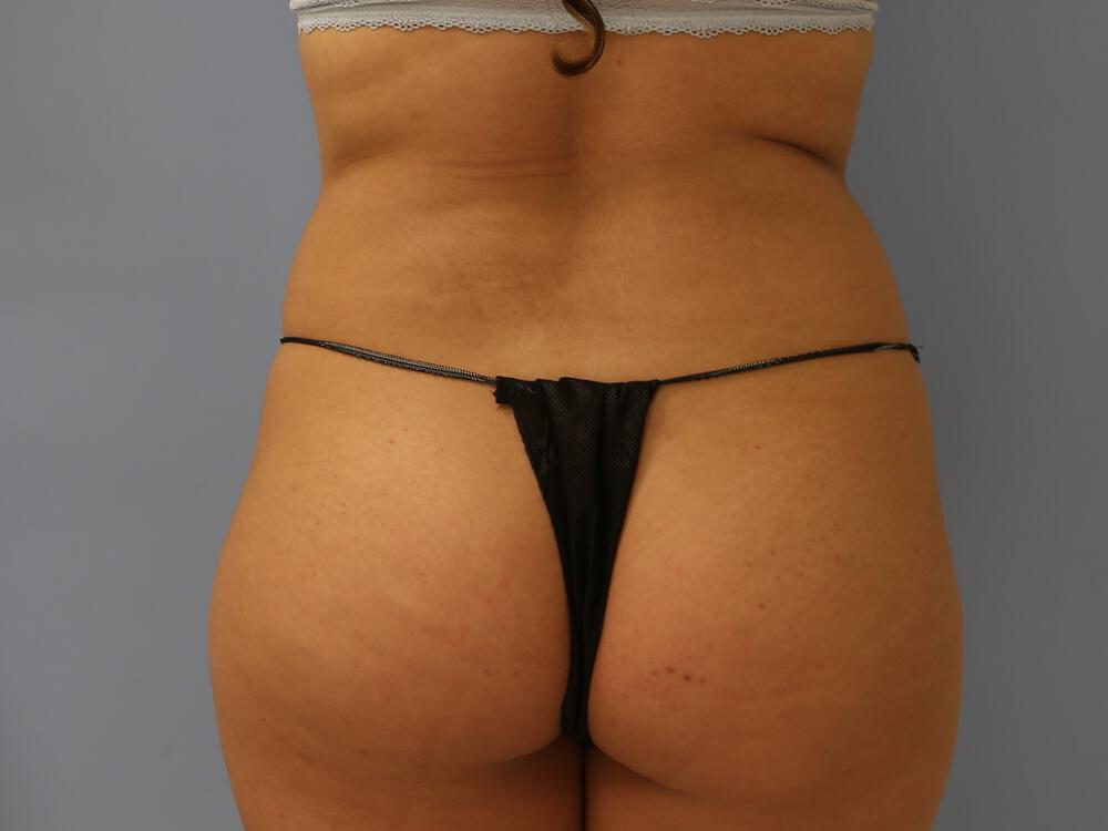 Buttocks Reshaping Before & After Image