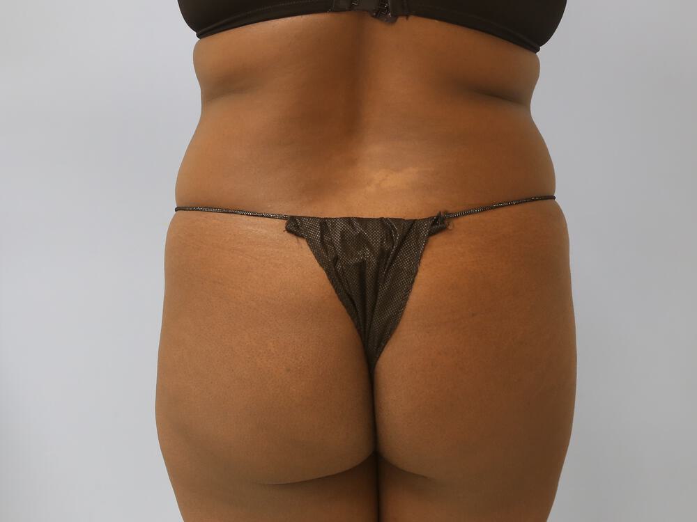 Buttocks Reshaping Before & After Image