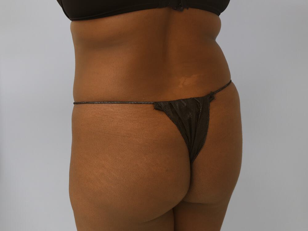 Buttocks Reshaping Before & After Image