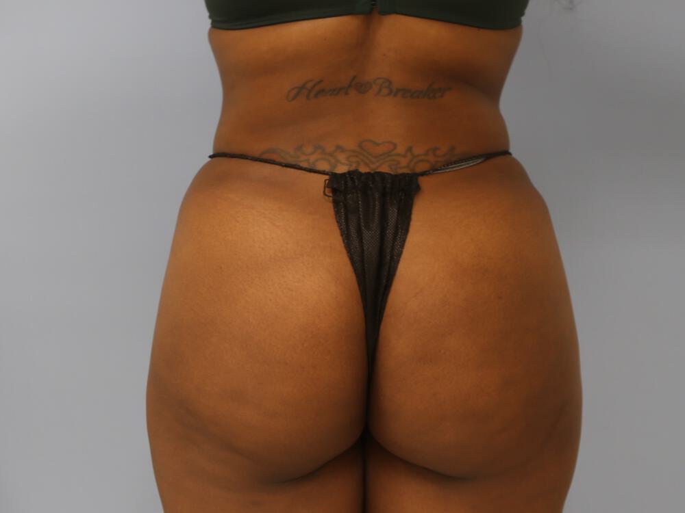 Buttocks Reshaping Before & After Image