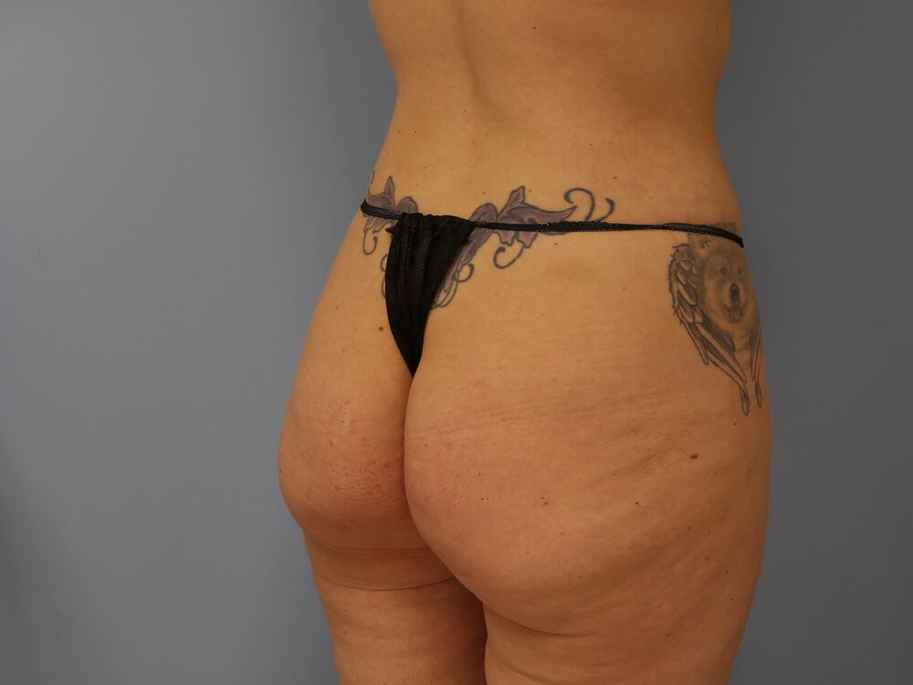 Buttocks Reshaping Before & After Image