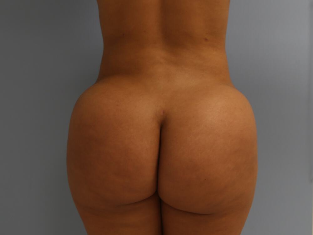 Buttocks Reshaping Before & After Image