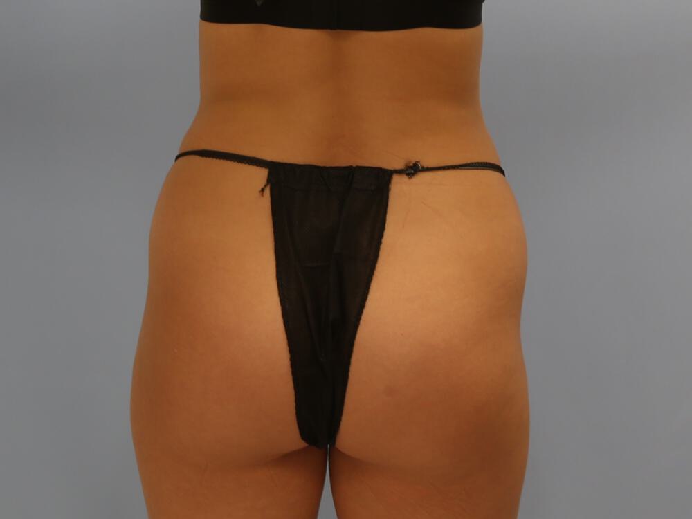 Buttocks Reshaping Before & After Image