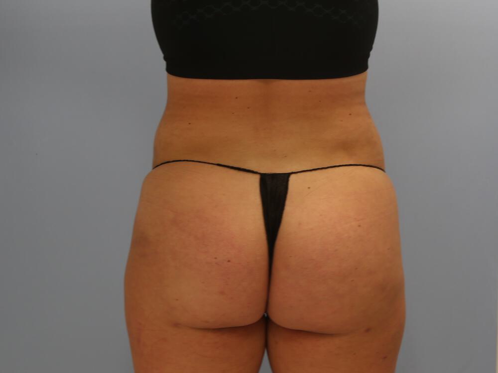 Buttocks Reshaping Before & After Image