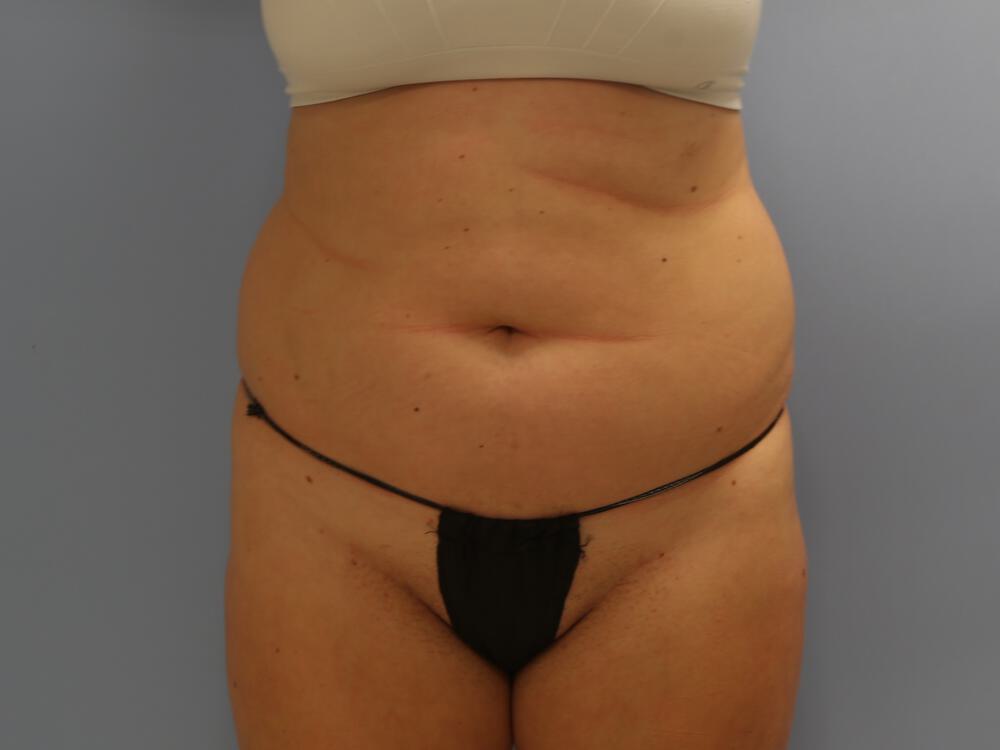 Buttocks Reshaping Before & After Image