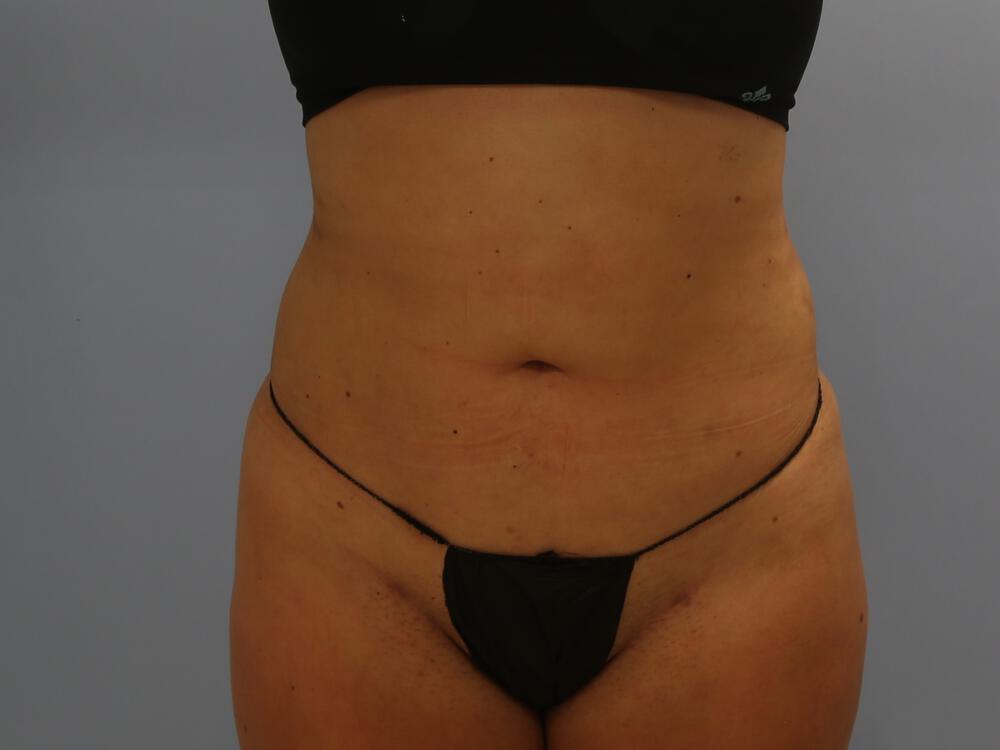 Buttocks Reshaping Before & After Image