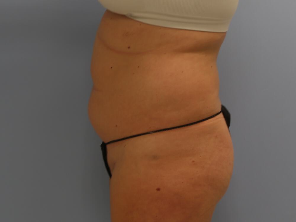 Buttocks Reshaping Before & After Image