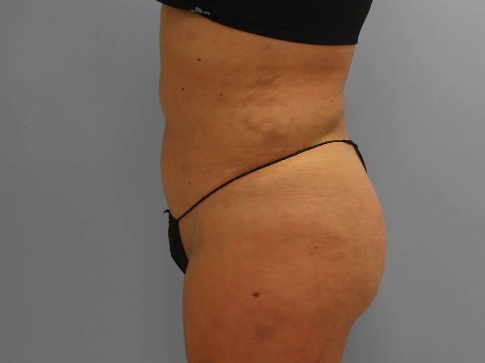 Buttocks Reshaping Before & After Image