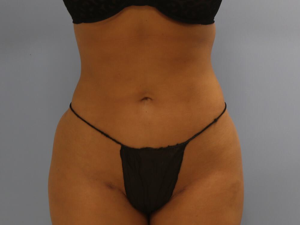 Buttocks Reshaping Before & After Image
