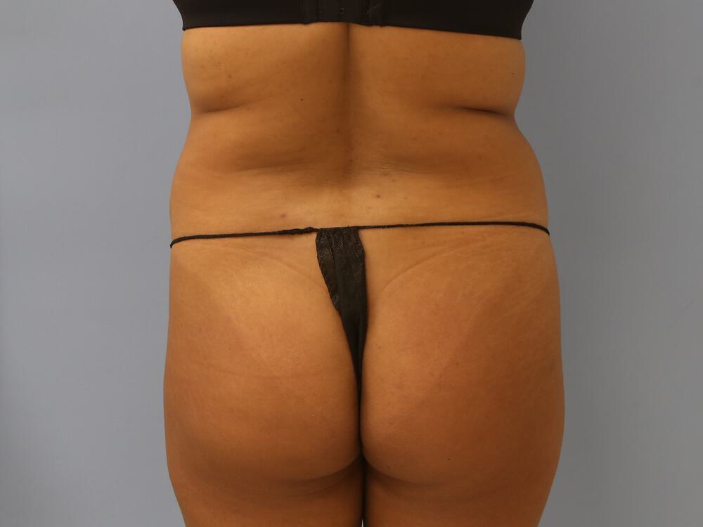 Buttocks Reshaping Before & After Image
