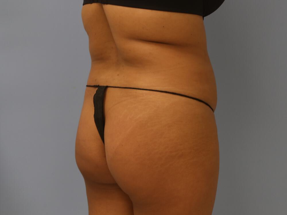 Buttocks Reshaping Before & After Image