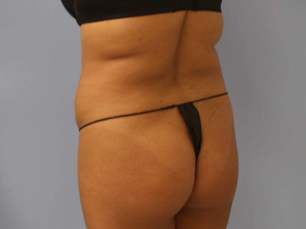 Buttocks Reshaping Before & After Image