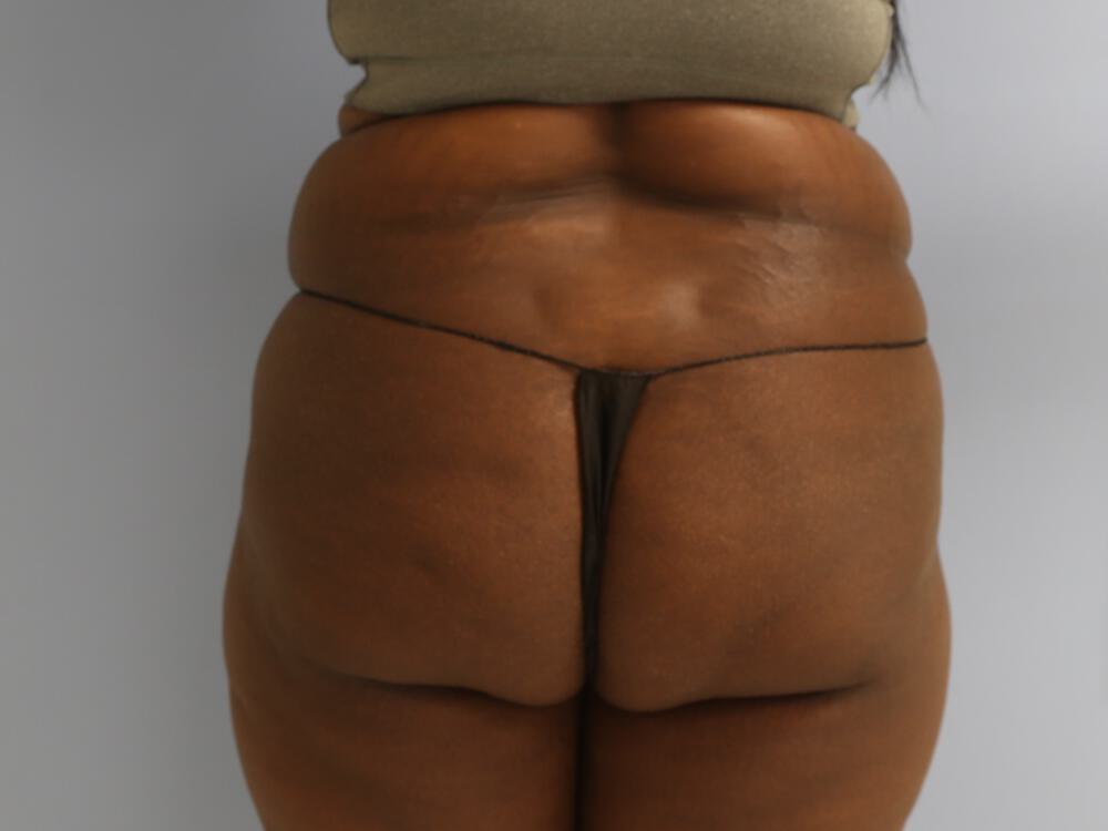 Buttocks Reshaping Before & After Image