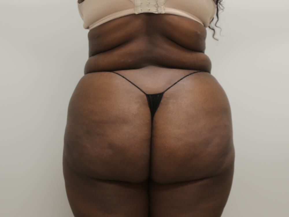 Buttocks Reshaping Before & After Image