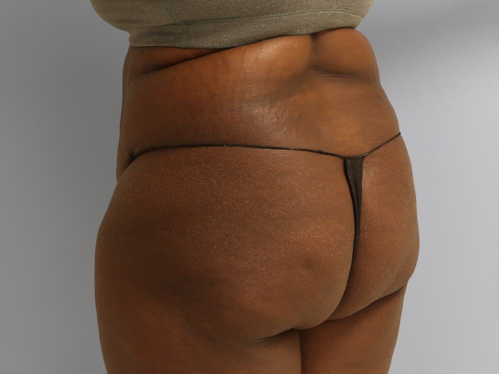 Buttocks Reshaping Before & After Image