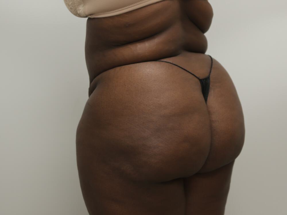 Buttocks Reshaping Before & After Image