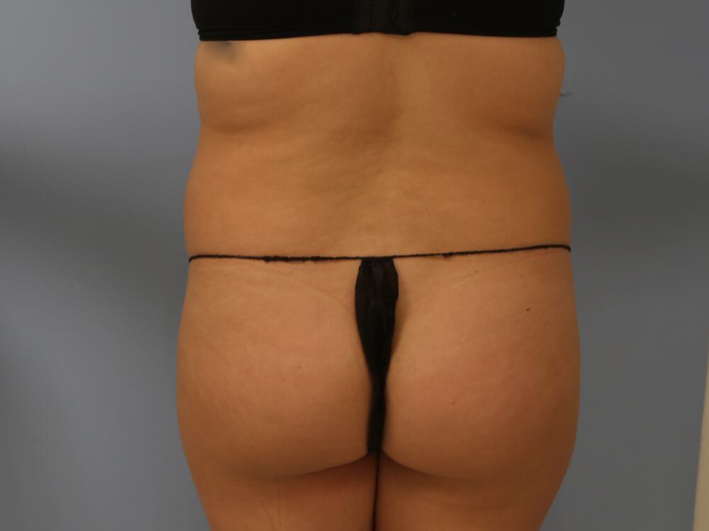 Buttocks Reshaping Before & After Image