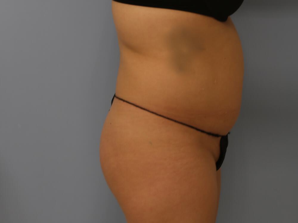 Buttocks Reshaping Before & After Image