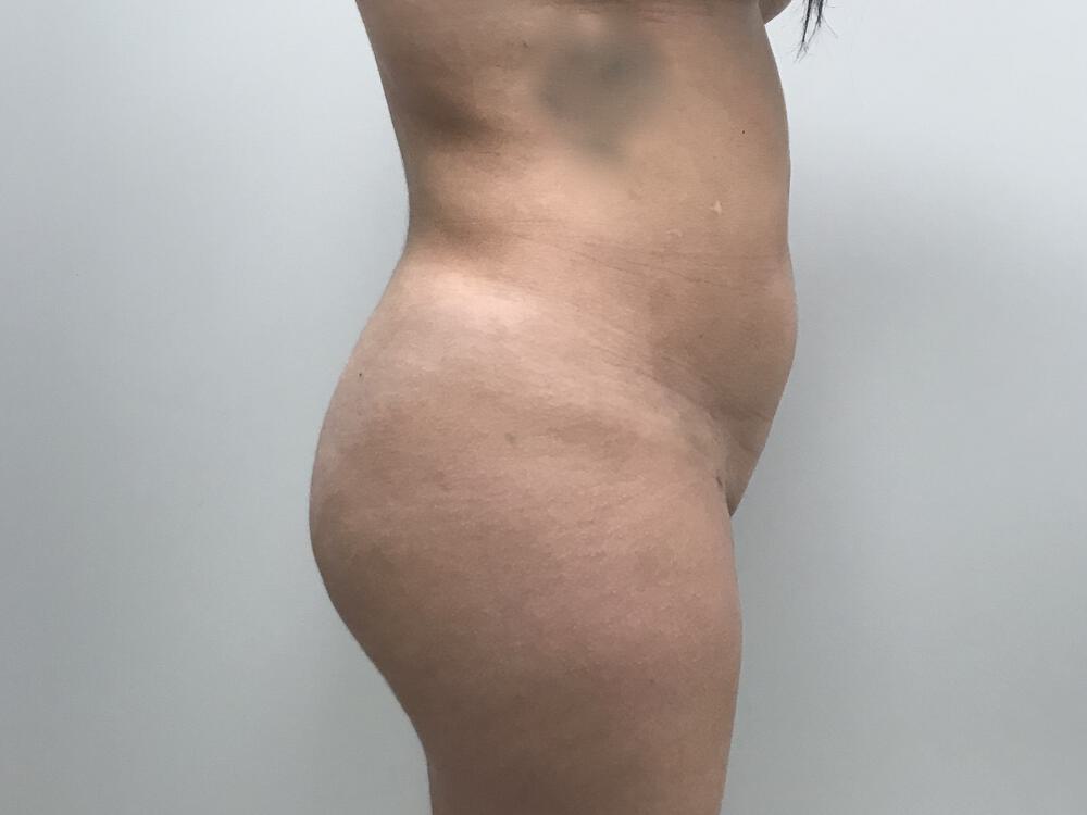 Buttocks Reshaping Before & After Image