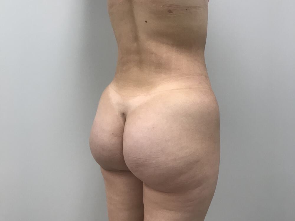 Buttocks Reshaping Before & After Image