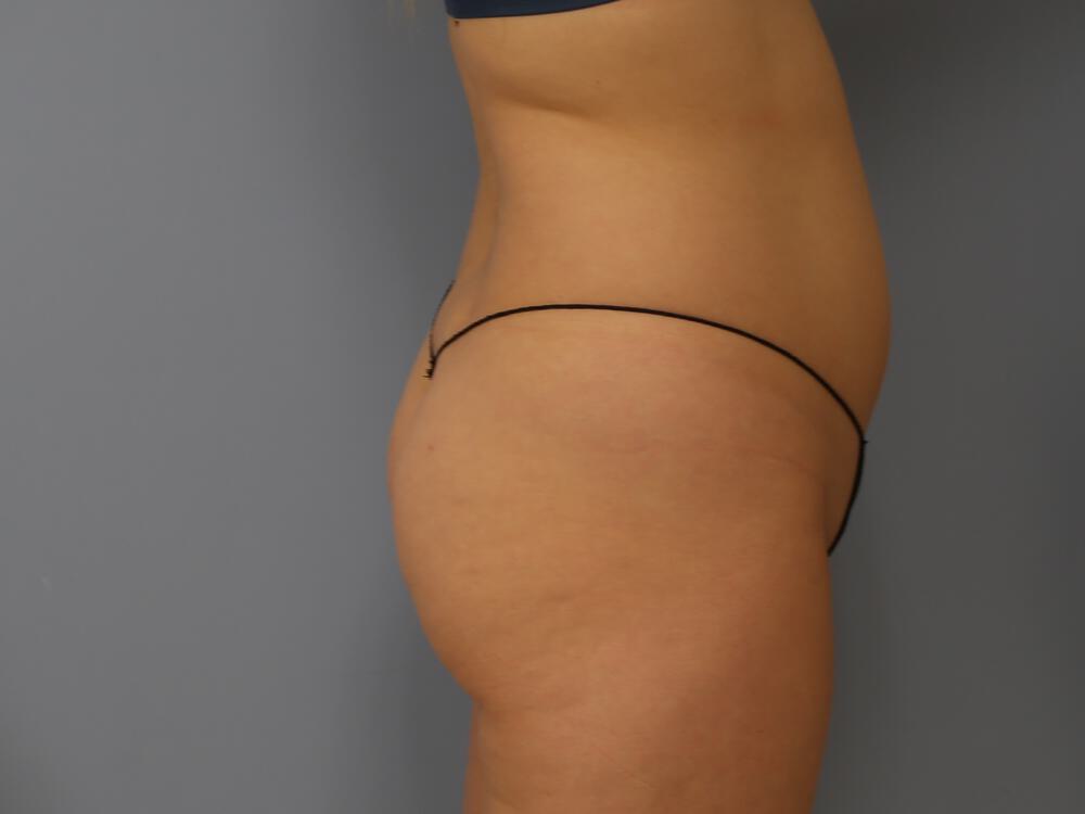 Buttocks Reshaping Before & After Image