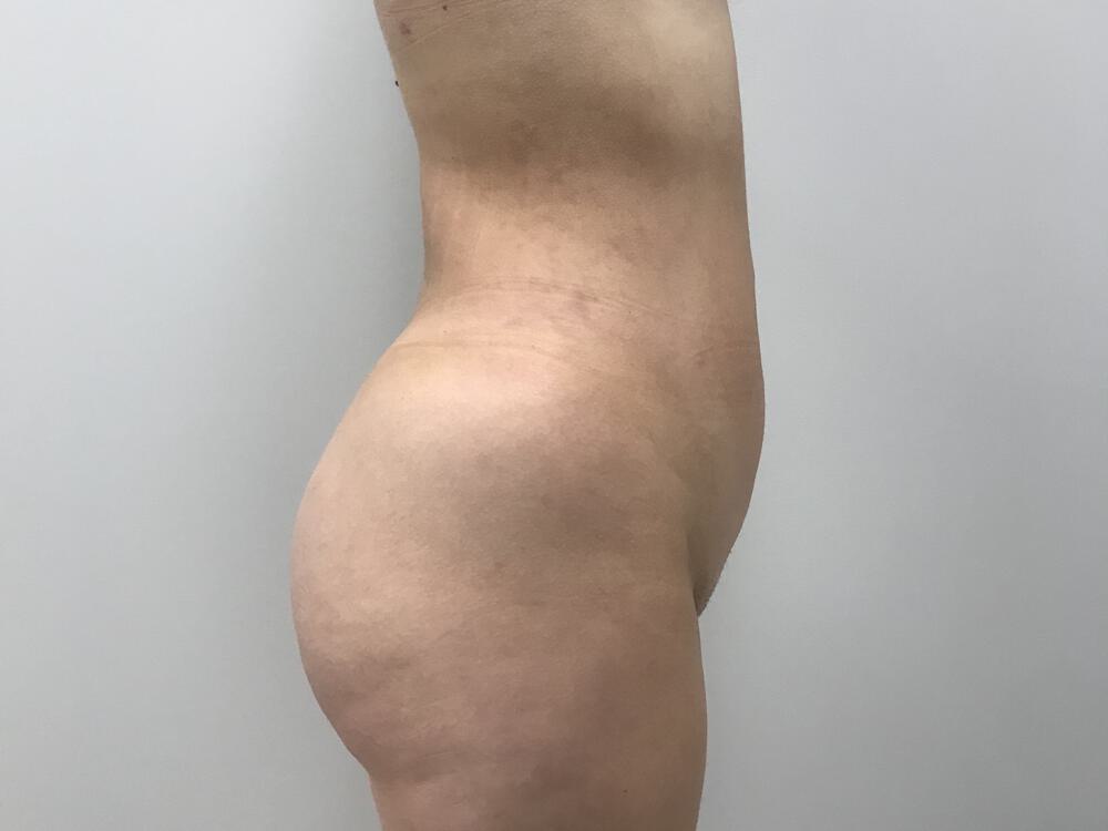 Buttocks Reshaping Before & After Image