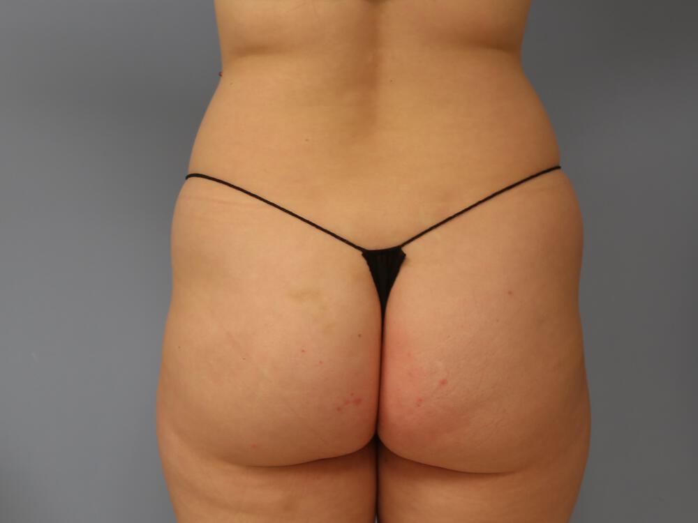 Buttocks Reshaping Before & After Image