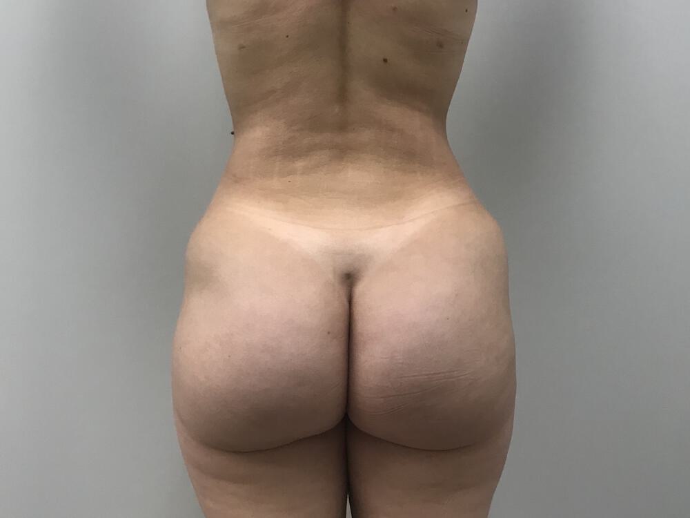Buttocks Reshaping Before & After Image