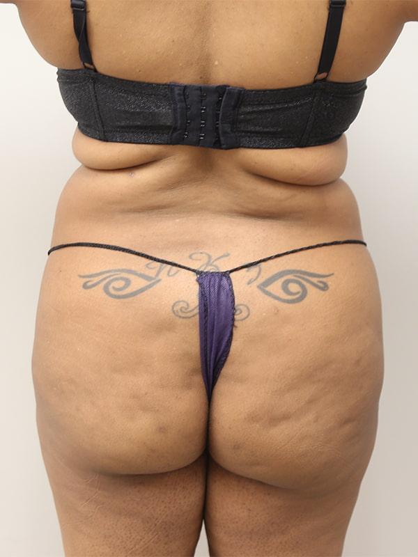 Buttocks Reshaping Before & After Image