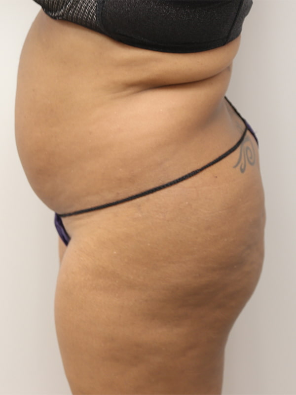 Buttocks Reshaping Before & After Image