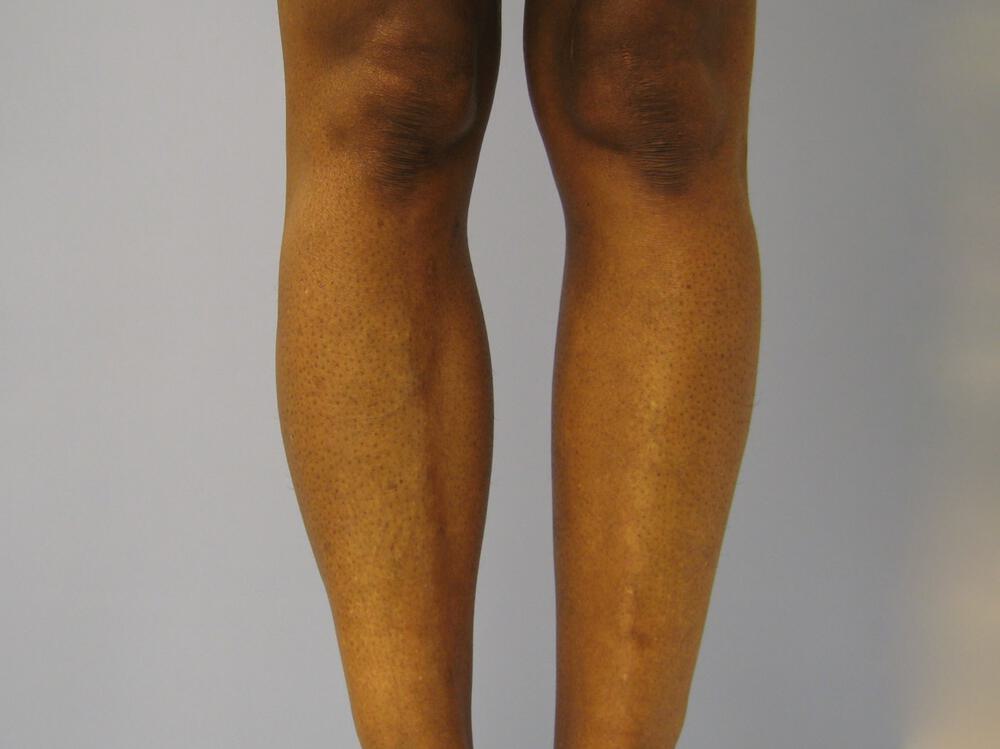 Calf Implants Before & After Image