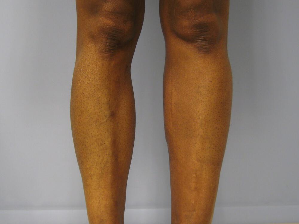 Calf Implants Before & After Image