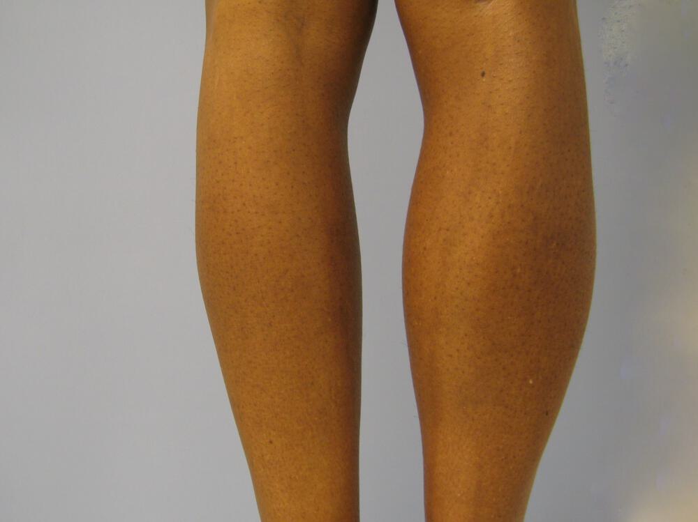 Calf Implants Before & After Image
